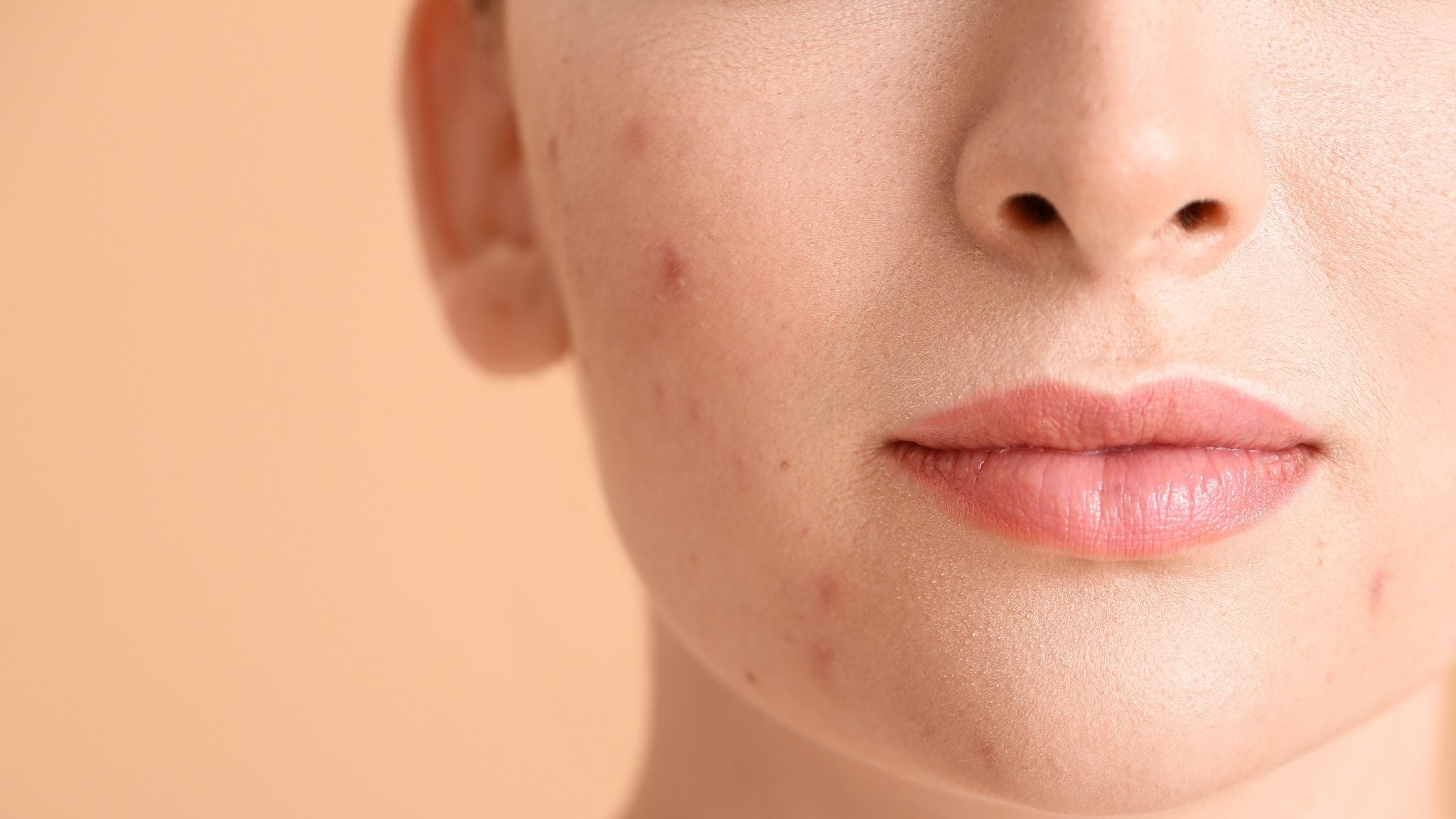 Spot Treatment for acne: How it usually works – Minimalist