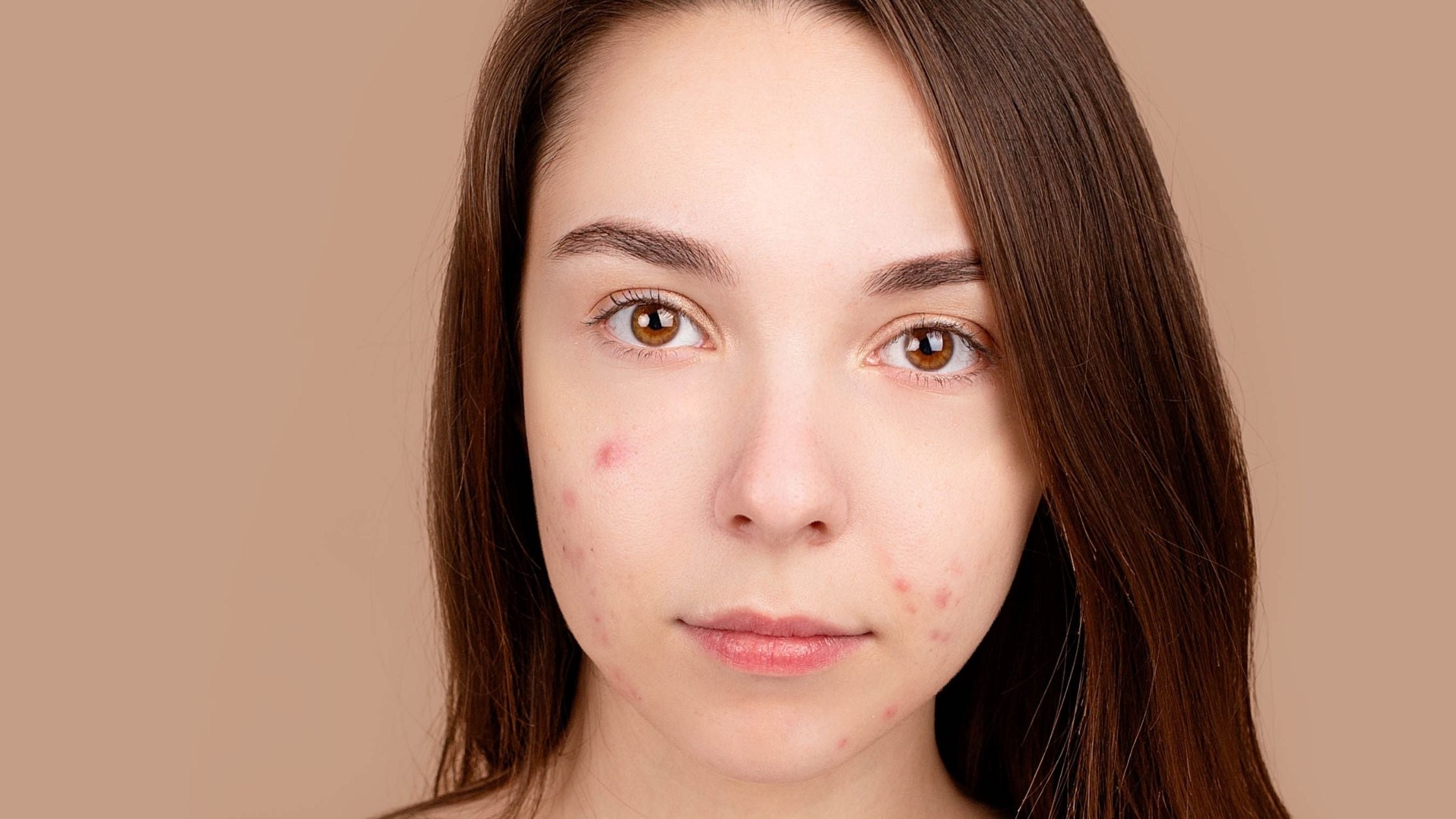 l carnitine facial breakouts Azelaic Acid or Salicylic Acid for blemishes? – Minimalist Studies reveal new clues Colour:Gummy Snake HCA