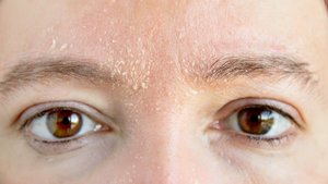 If You Have Dry Skin, Here’s How You Can Take Care Of It And Make Sure It Looks Healthy