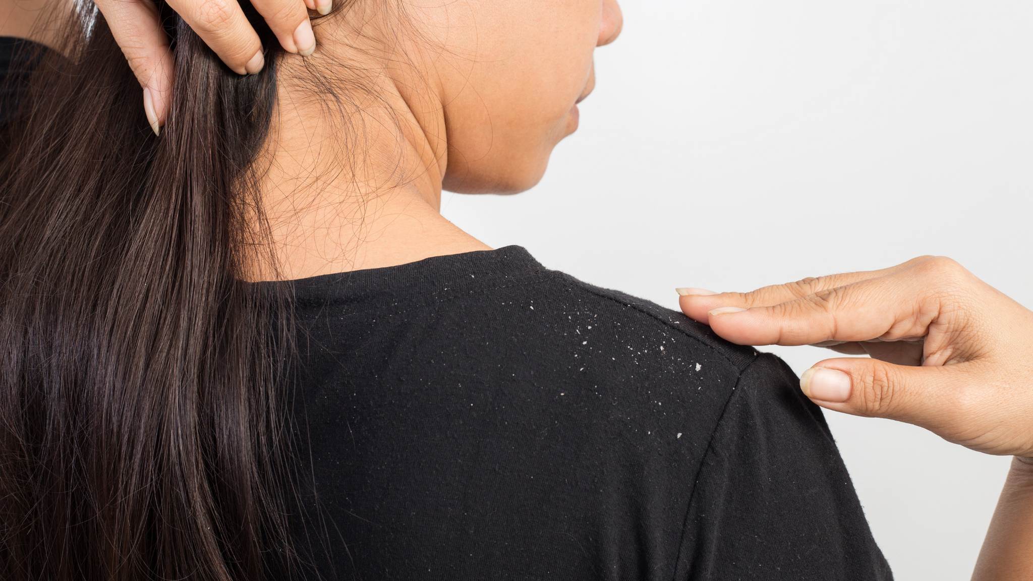 Here’s How You Can Prevent Your Scalp From Itchy White or Yellow Flakes