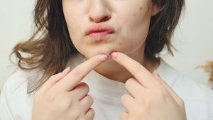 How does Salicylic Acid (BHA) help Acne-Prone Skin?