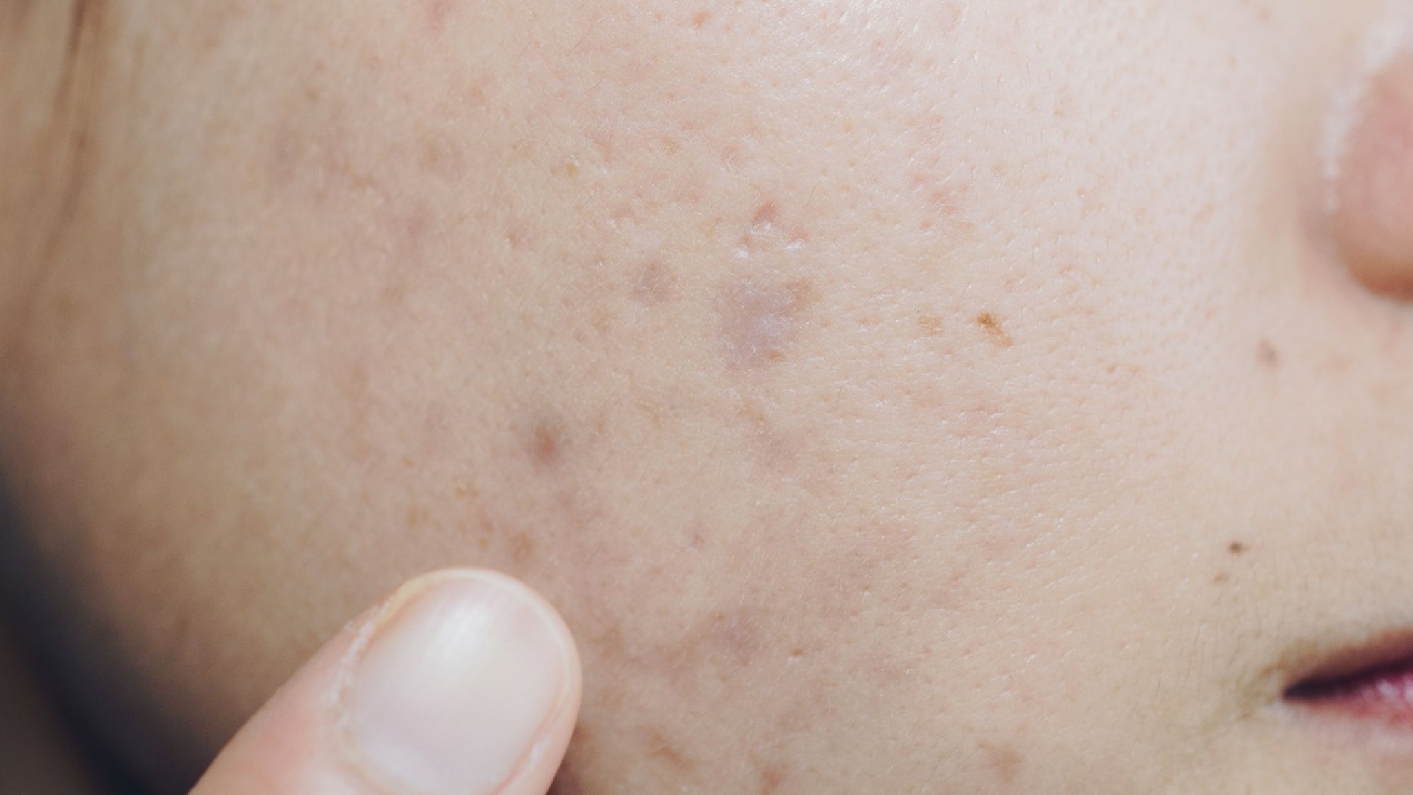 How to Get Rid of Acne - Scars As Recommended By Experts