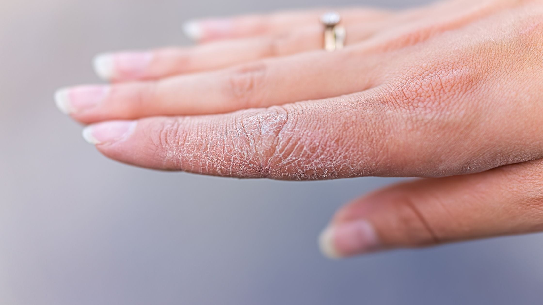 Dry Hands: Causes and Treatment – Minimalist