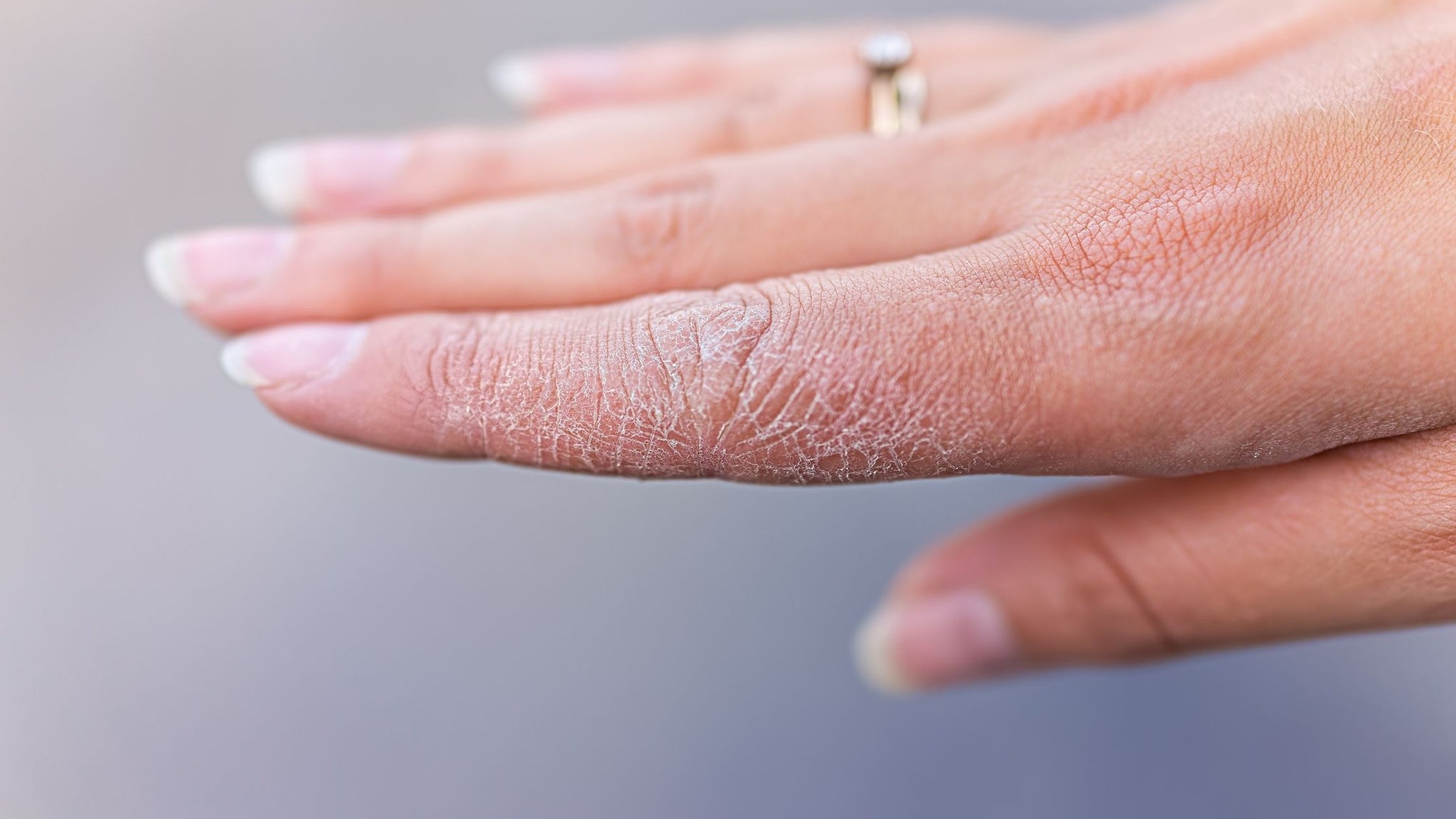 How To Get Rid Of Dry Hands? Causes & Treatment