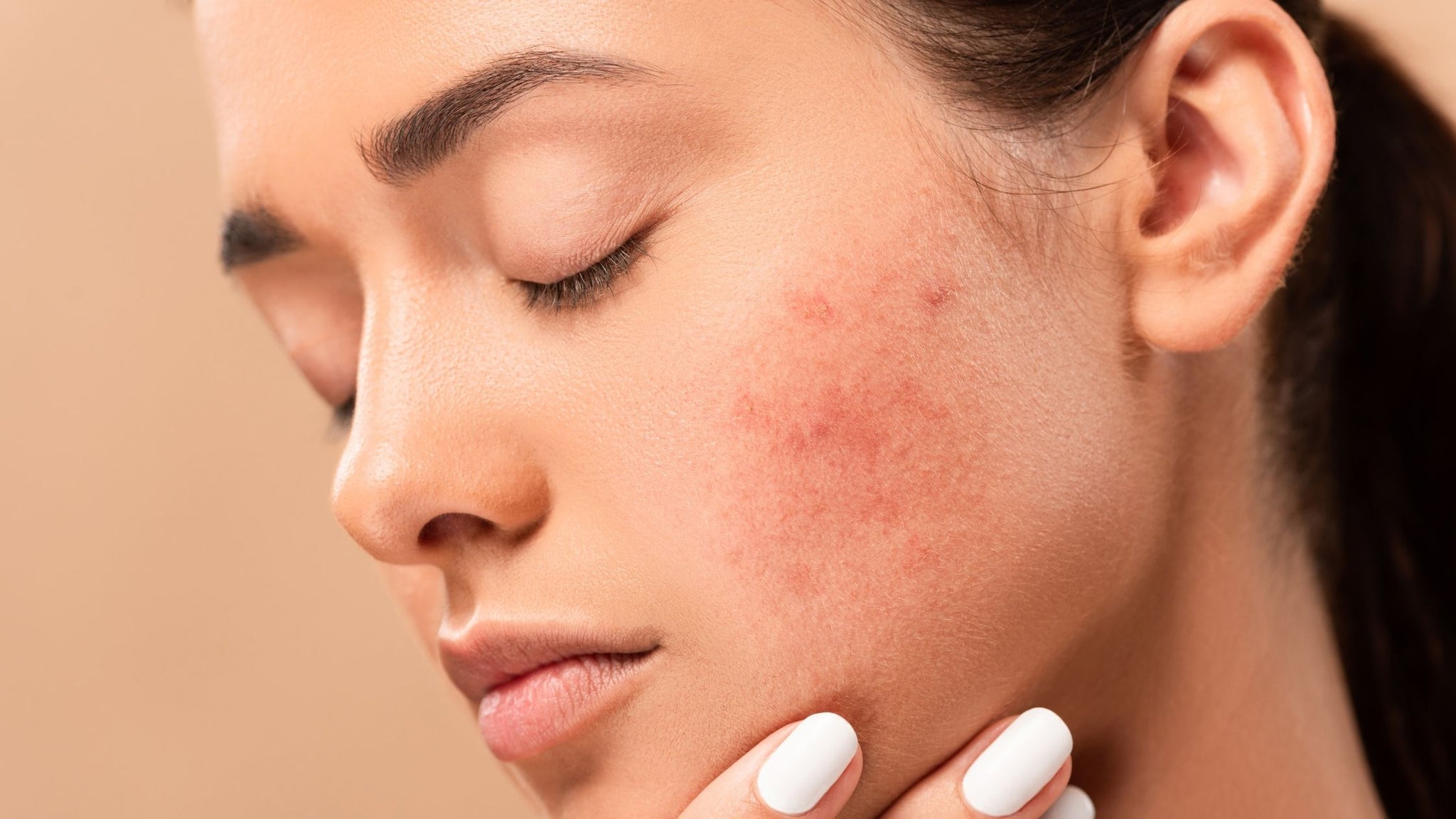 Hormonal Acne: Causes and Prevention