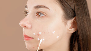 Adult acne can be agonizing! Here's how Retinoids can help