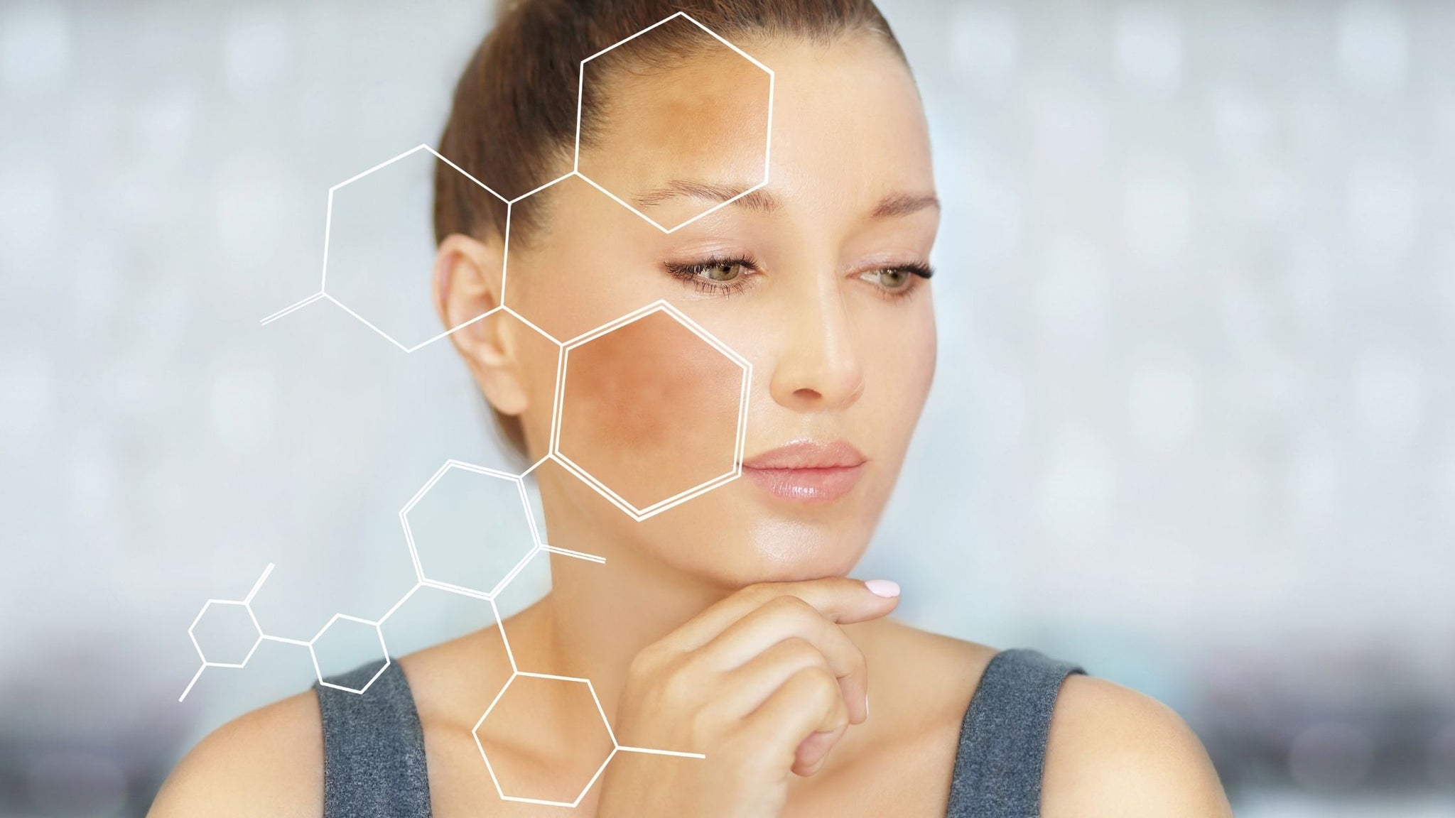 What is Melasma and how to treat it?