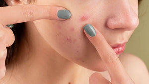 Exclusive tips to prevent and reduce acne scars or pimple marks